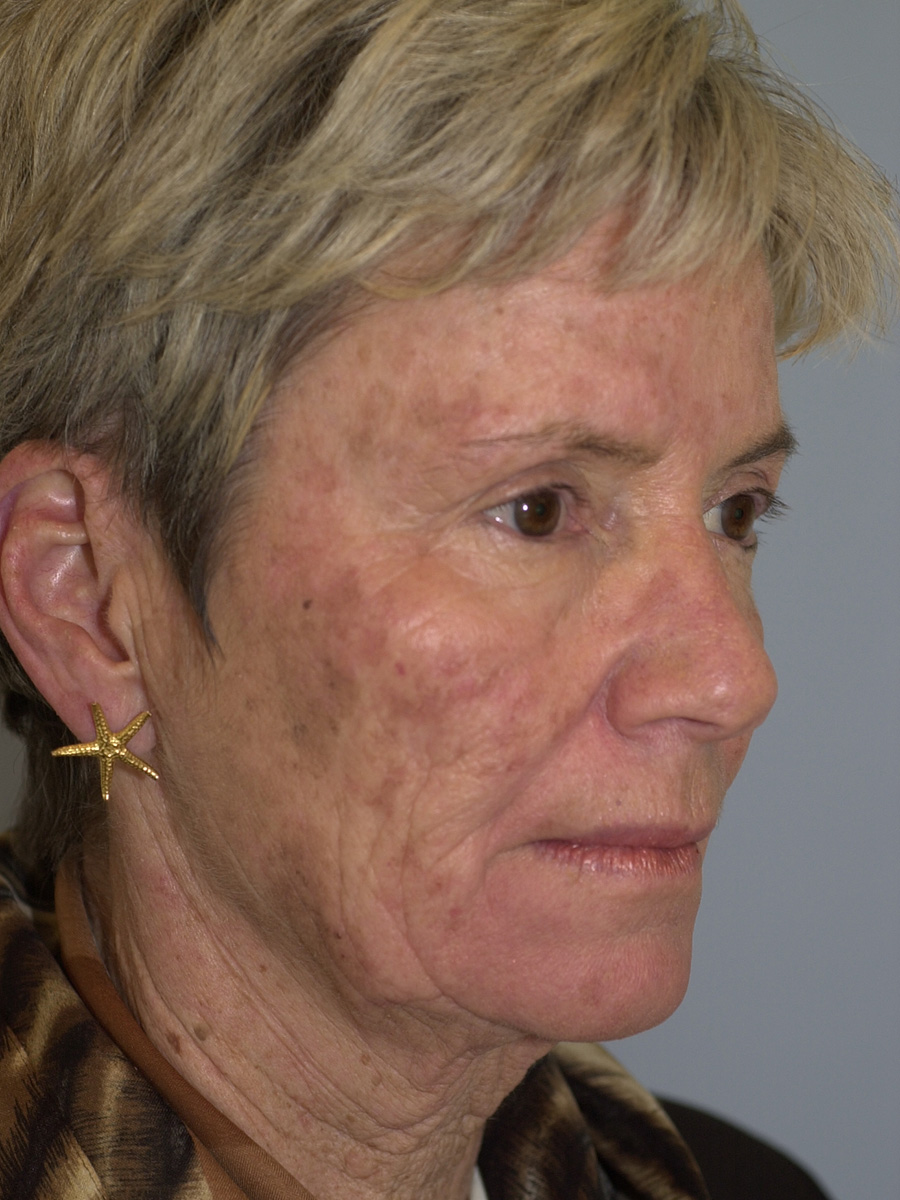 Case--3448 | Before Face 2