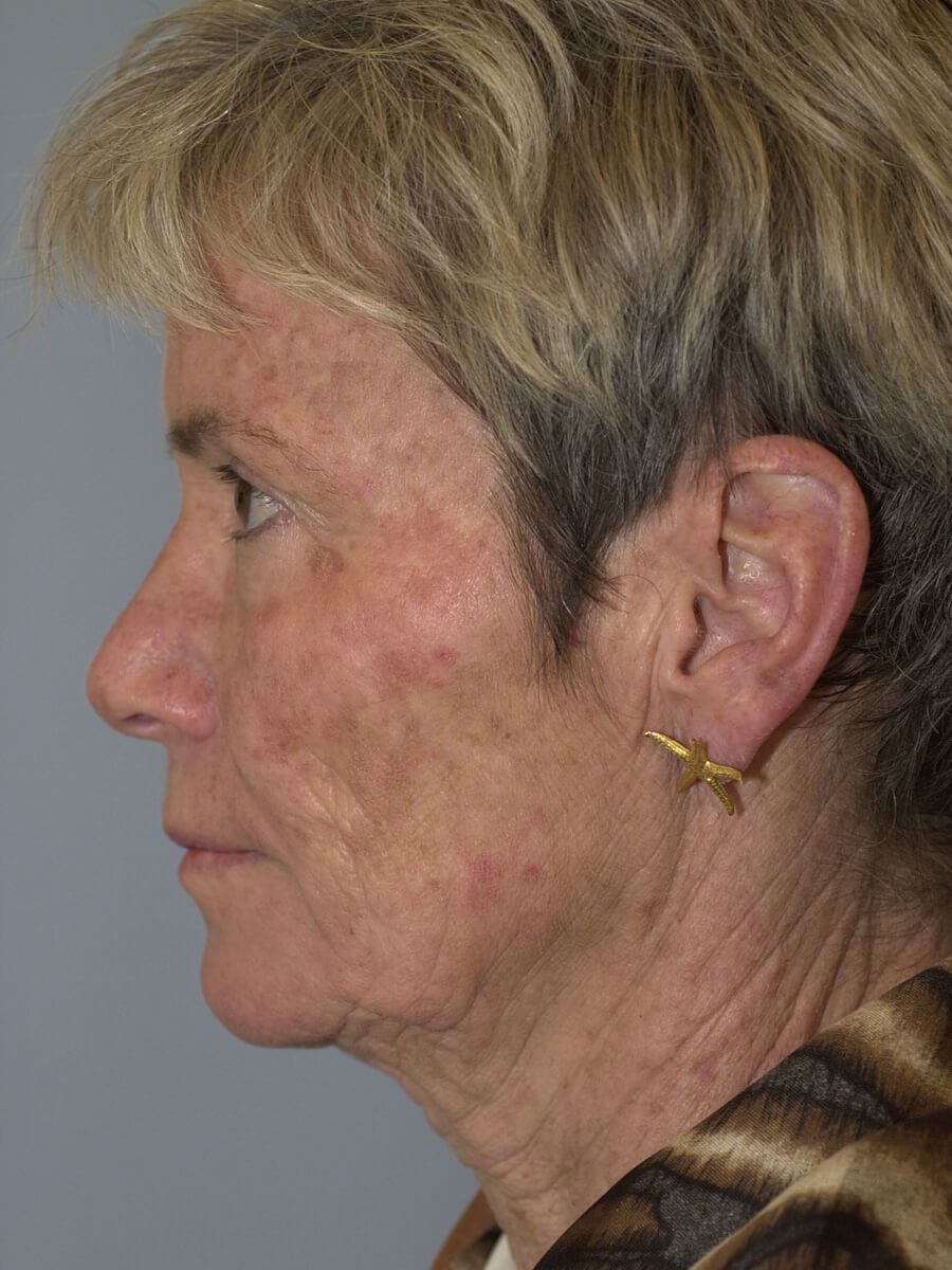 Case--3448 | Before Face 4