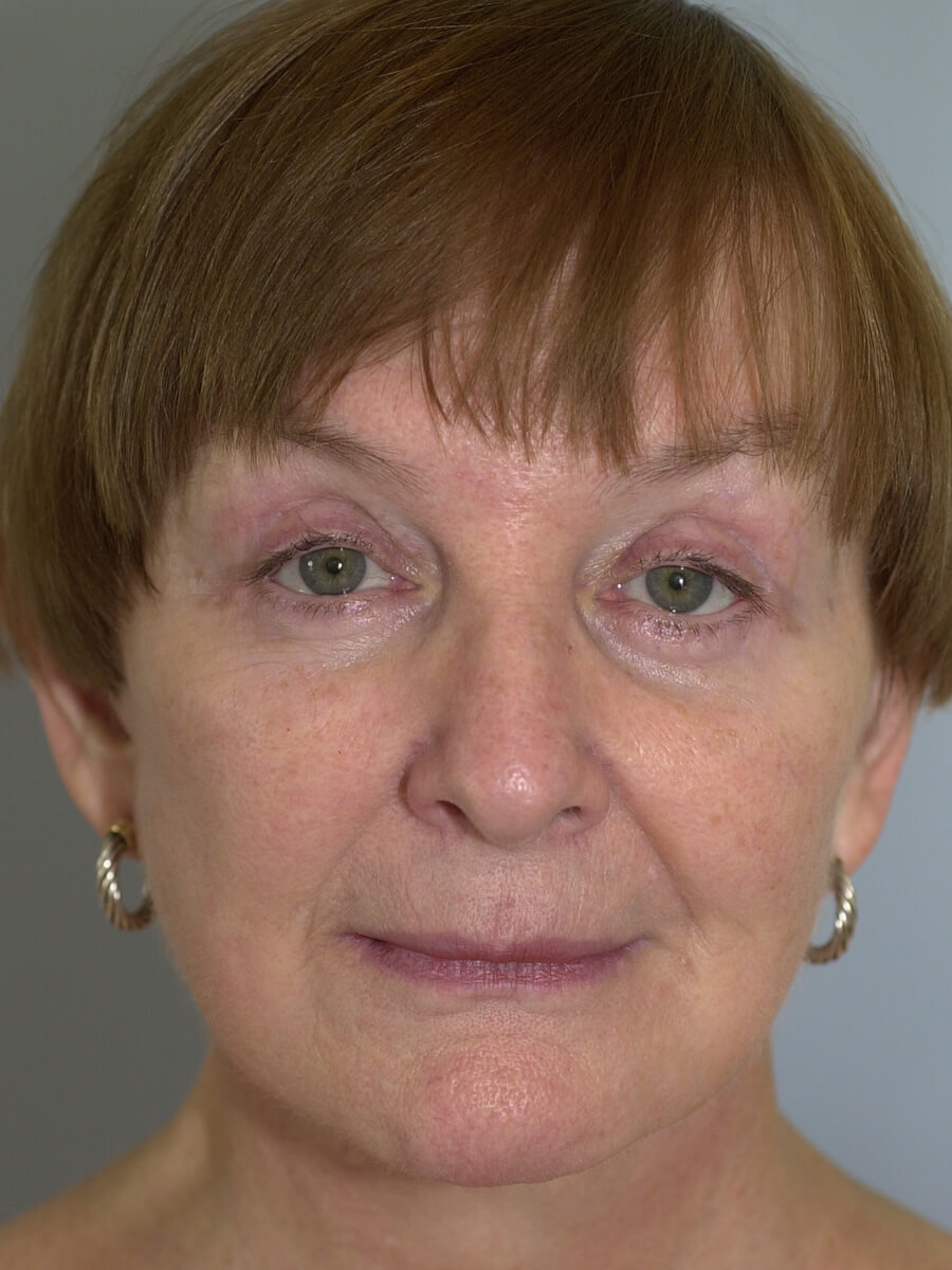 Case--9554 | After Face 1