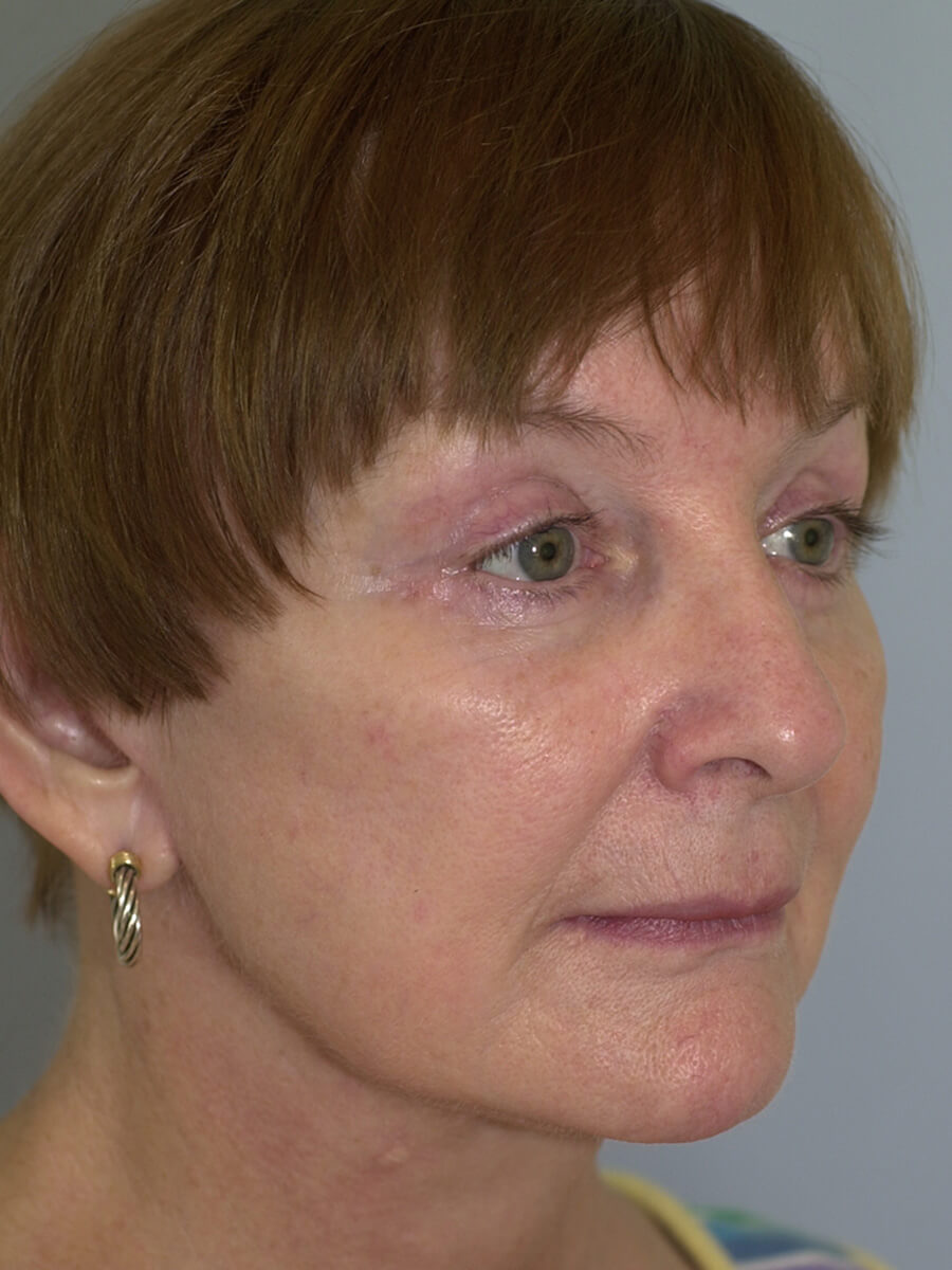 Case--9554 | After Face 2