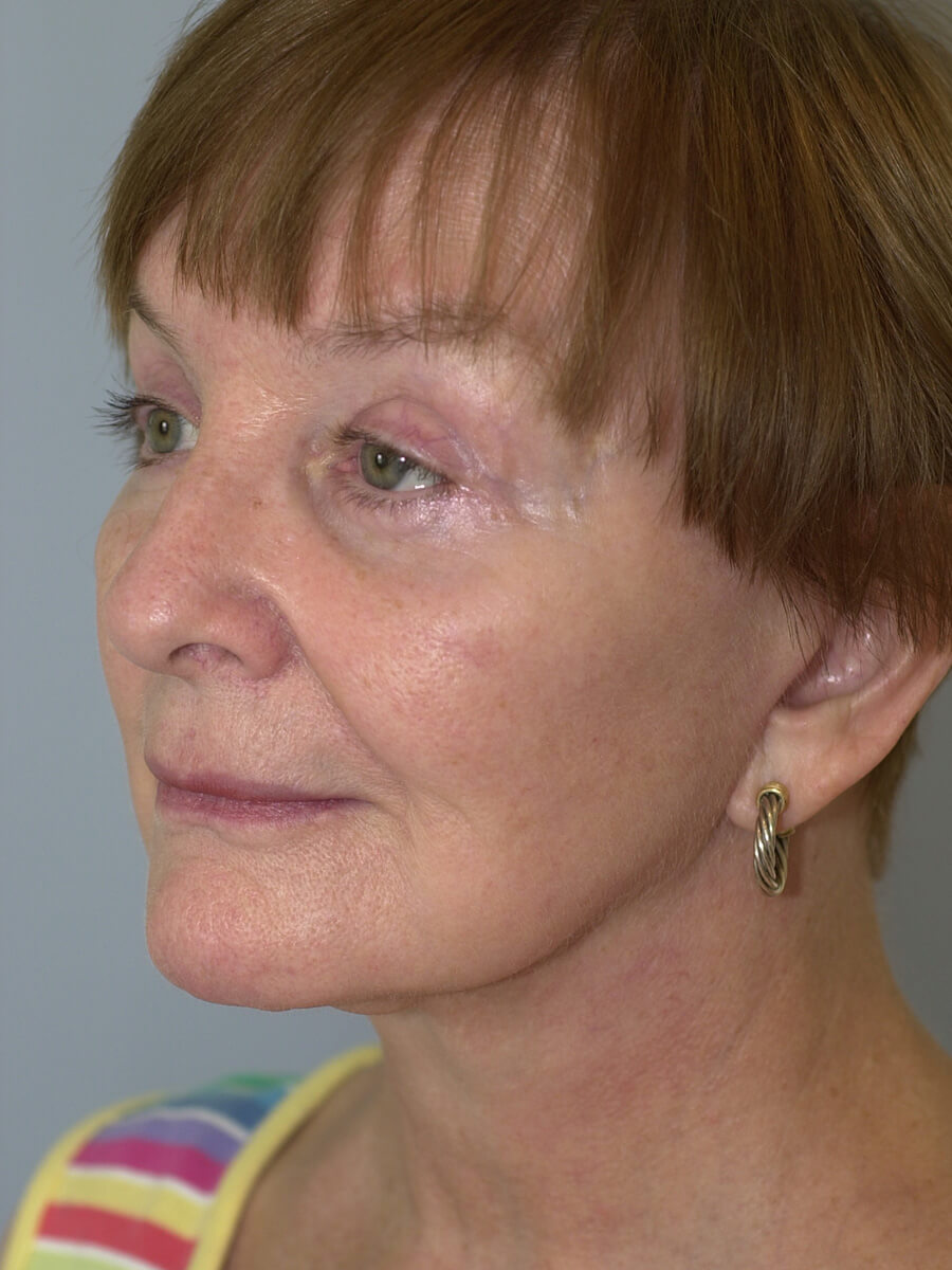 Case--9554 | After Face 4