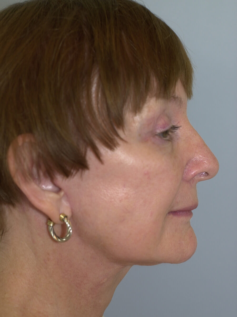 Case--9554 | After Face 3