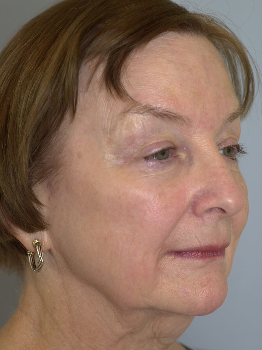 Case--9554 | Before Face 2