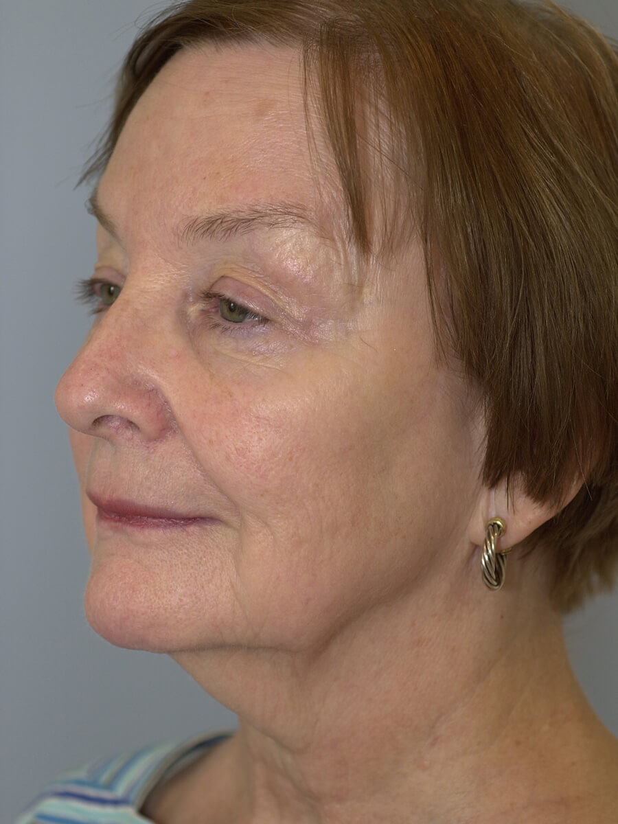 Case--9554 | Before Face 4