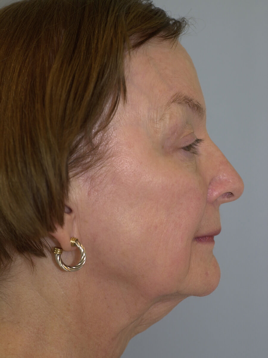 Case--9554 | Before Face 3