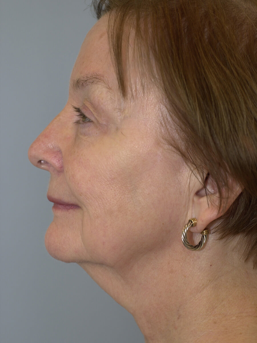 Case--9554 | Before Face 5