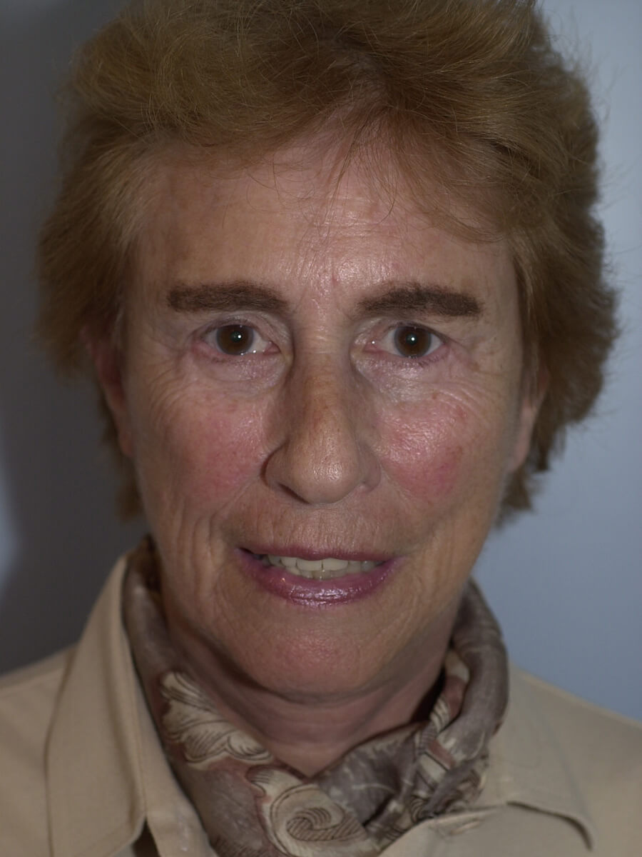 Case--5540 | After Facelift 1