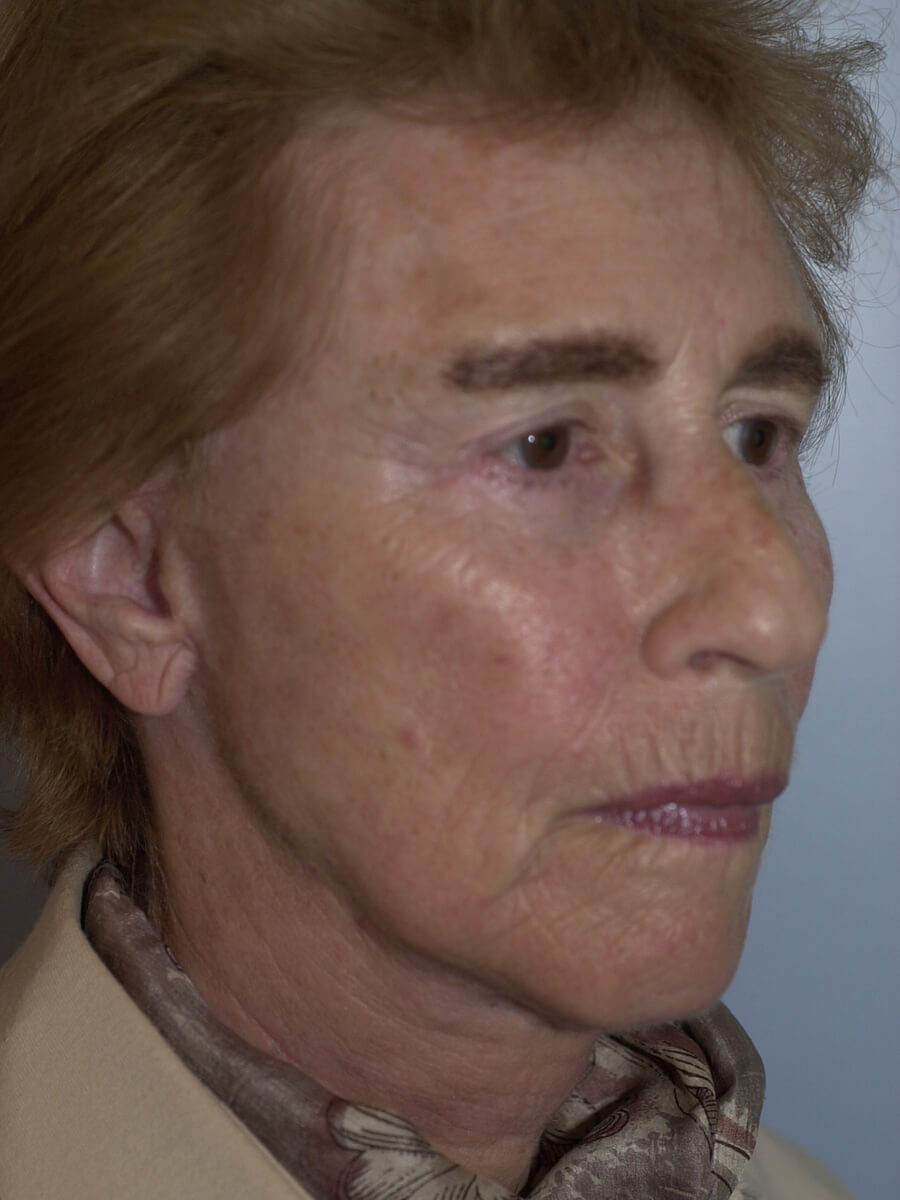 Case--5540 | After Facelift 2