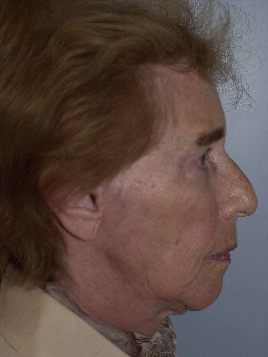 Case--5540 | After Facelift 3