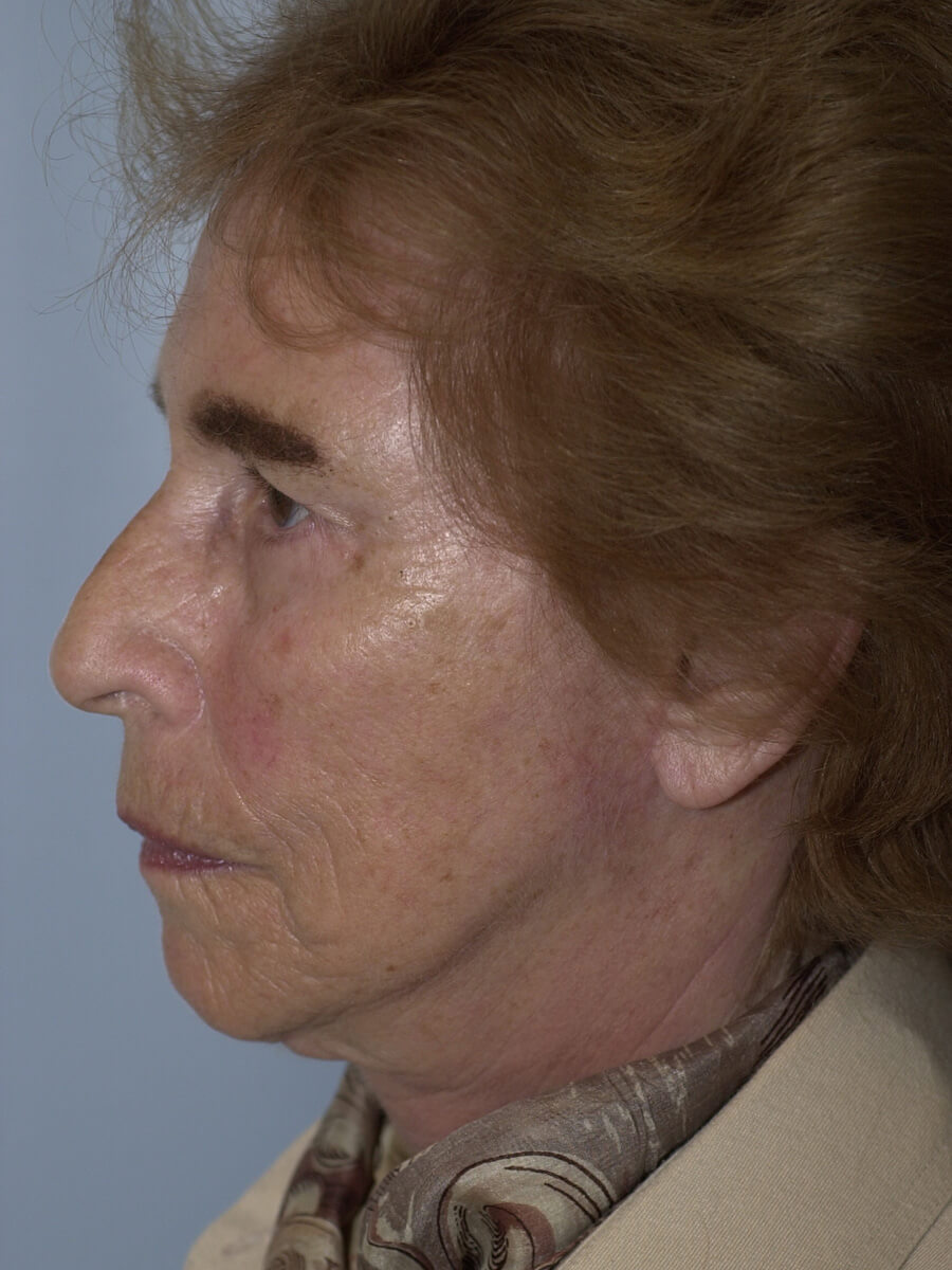 Case--5540 | After Facelift 5