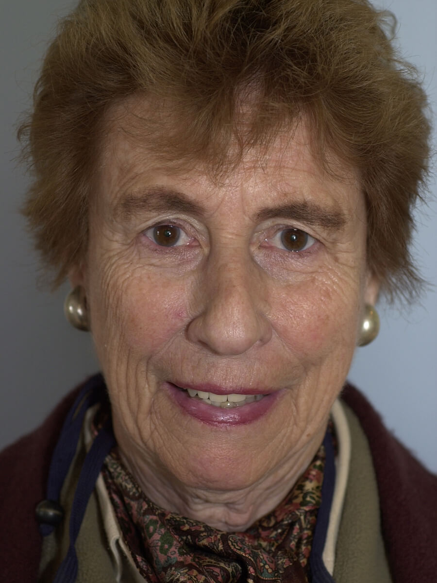 Case--5540 | Before Facelift 1