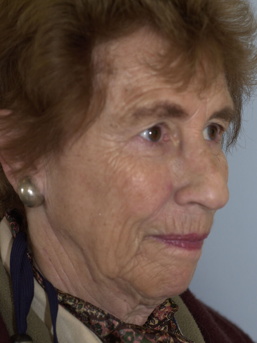 Case--5540 | Before Facelift 2