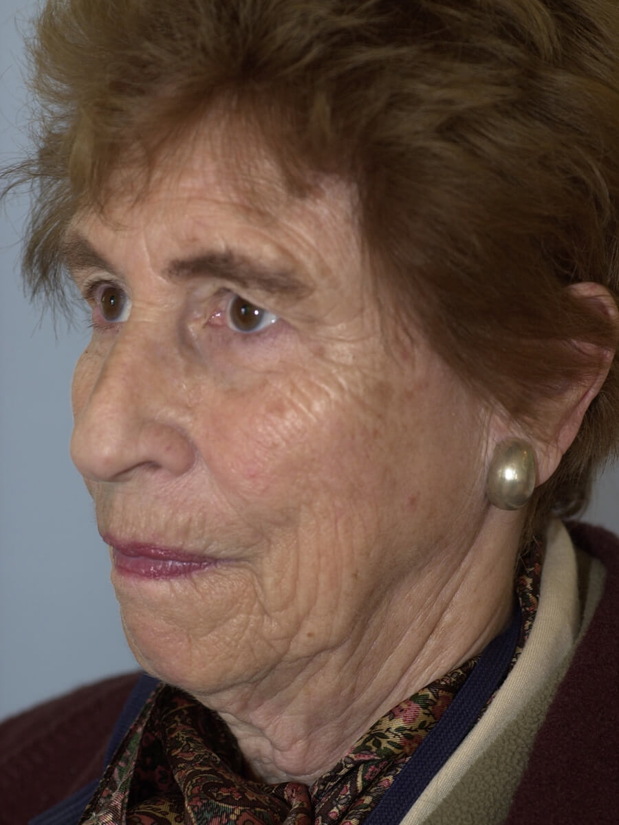 Case--5540 | Before Facelift 4