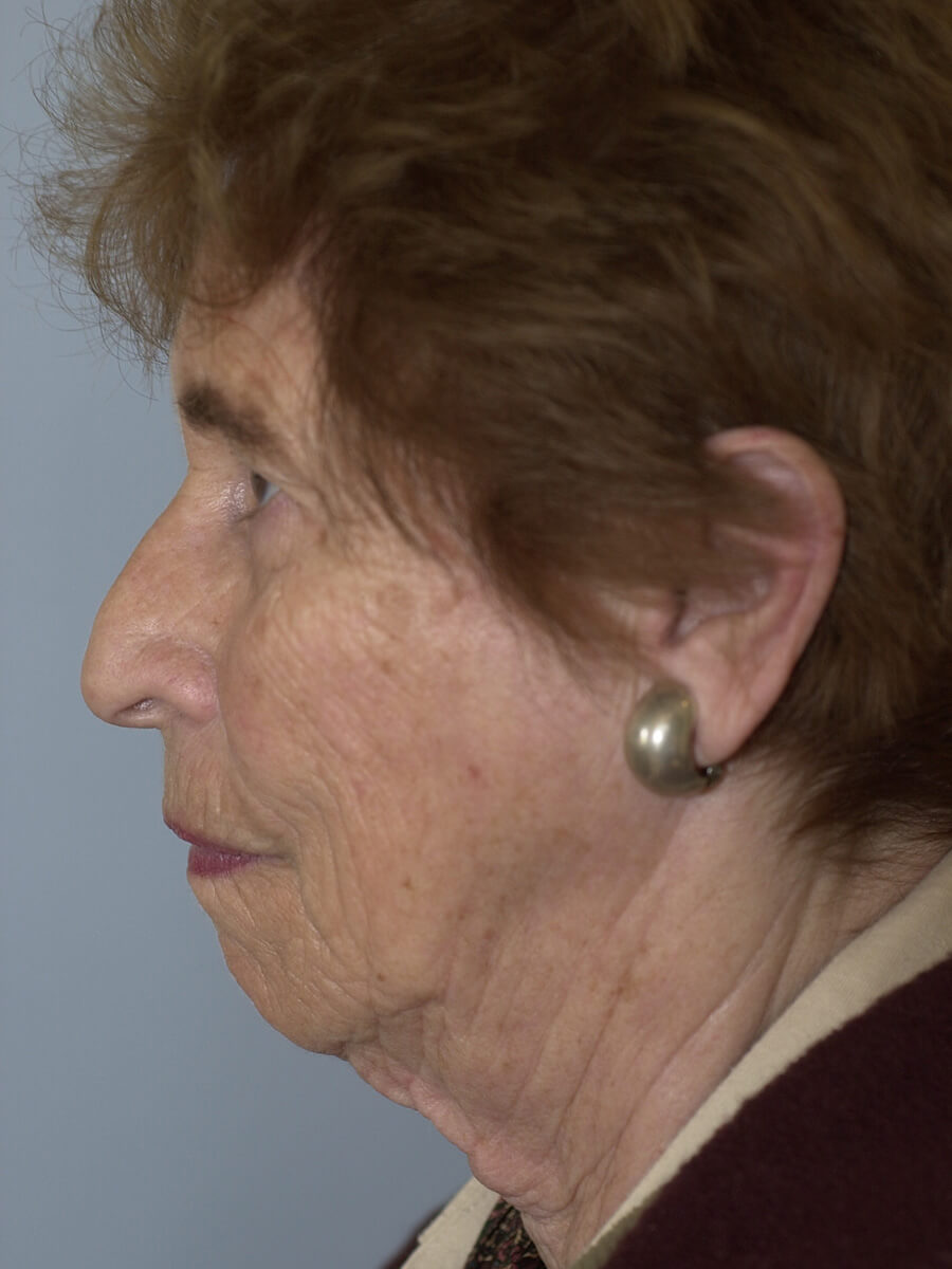 Case--5540 | Before Facelift 5