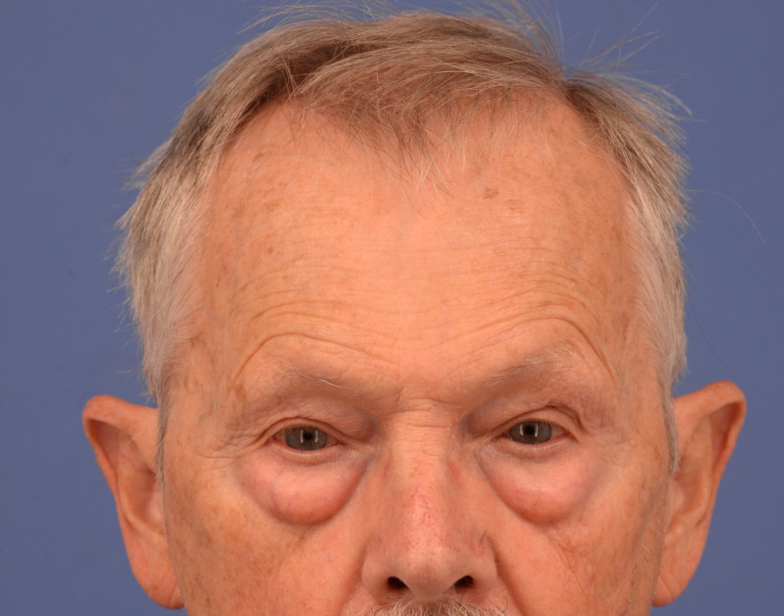 Case--7598 | Before Lower Blepharoplasty 1