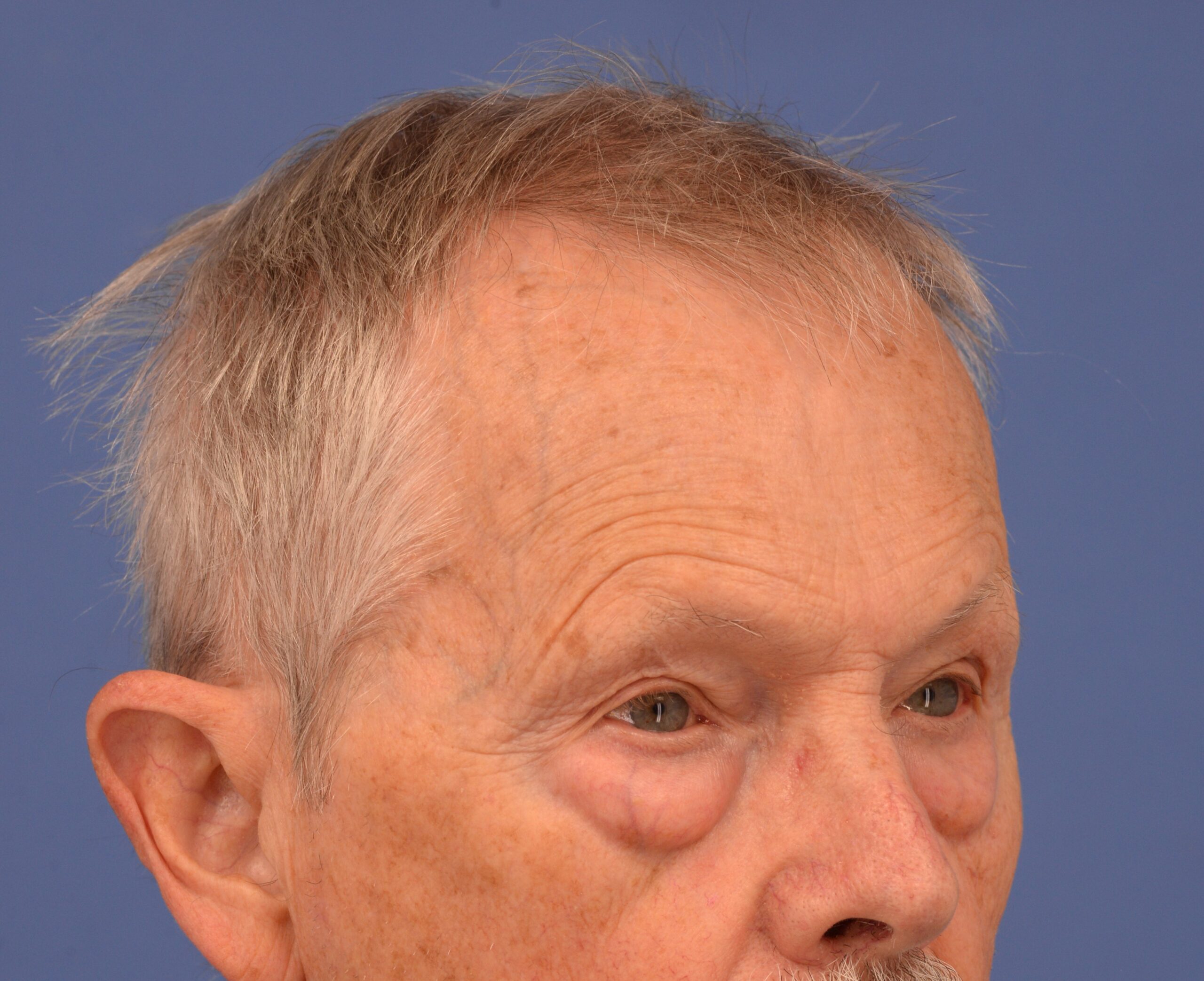 Case--7598 | Before Lower Blepharoplasty 2