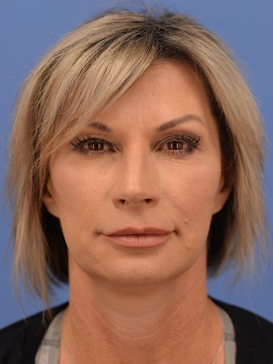 Case--5906 | After Face 1