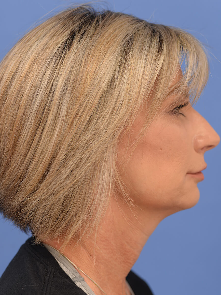 Case--5906 | After Face 3