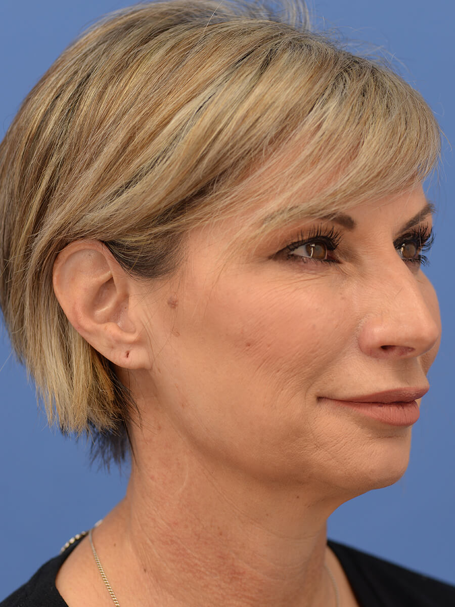 Case--5906 | Before Face 2