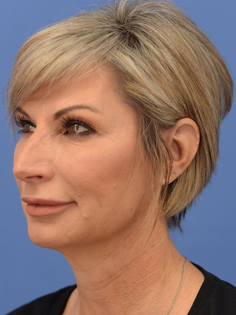 Case--5906 | Before Face 4