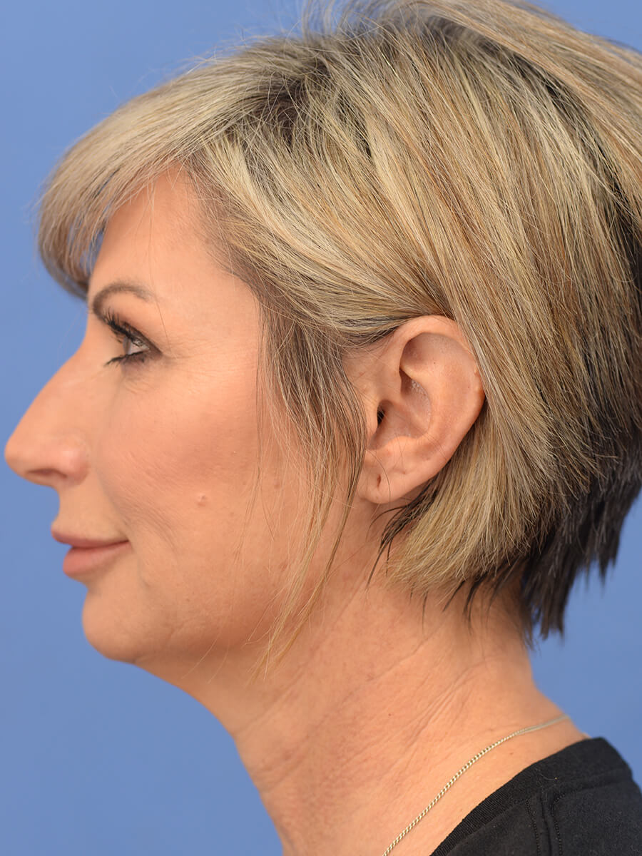 Case--5906 | Before Face 5