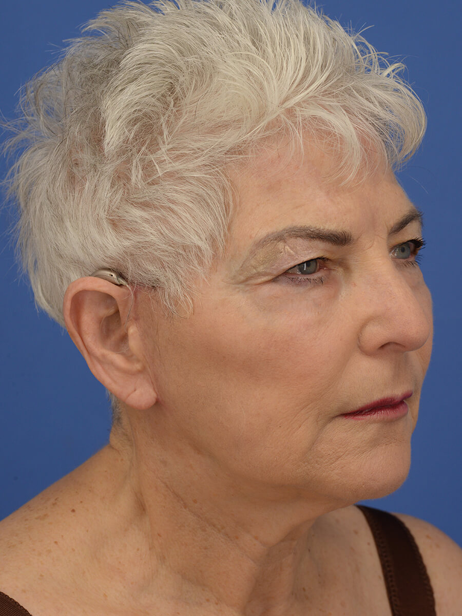 Case--5520 | After Face 4