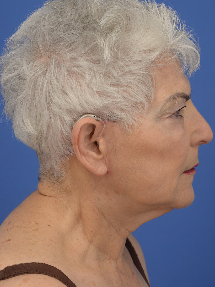 Case--5520 | After Face 5