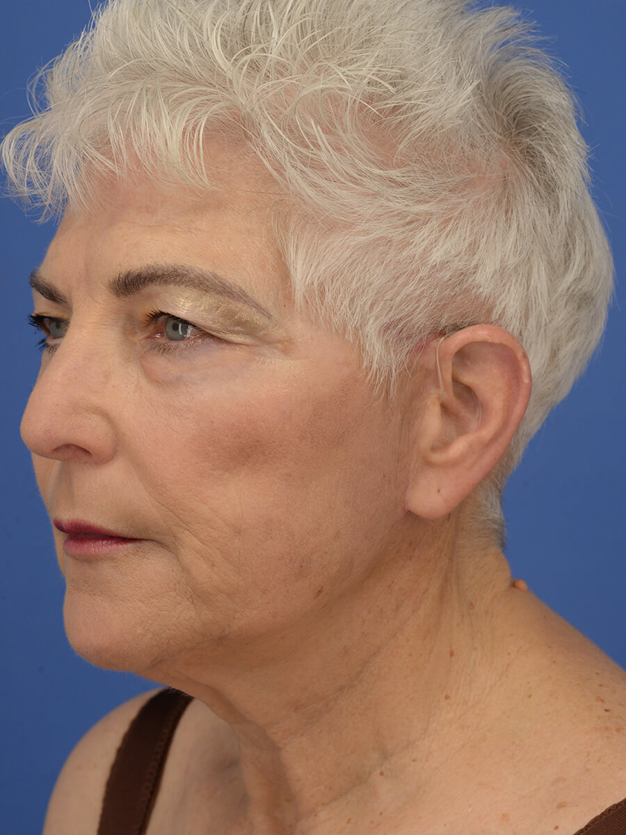 Case--5520 | After Face 2