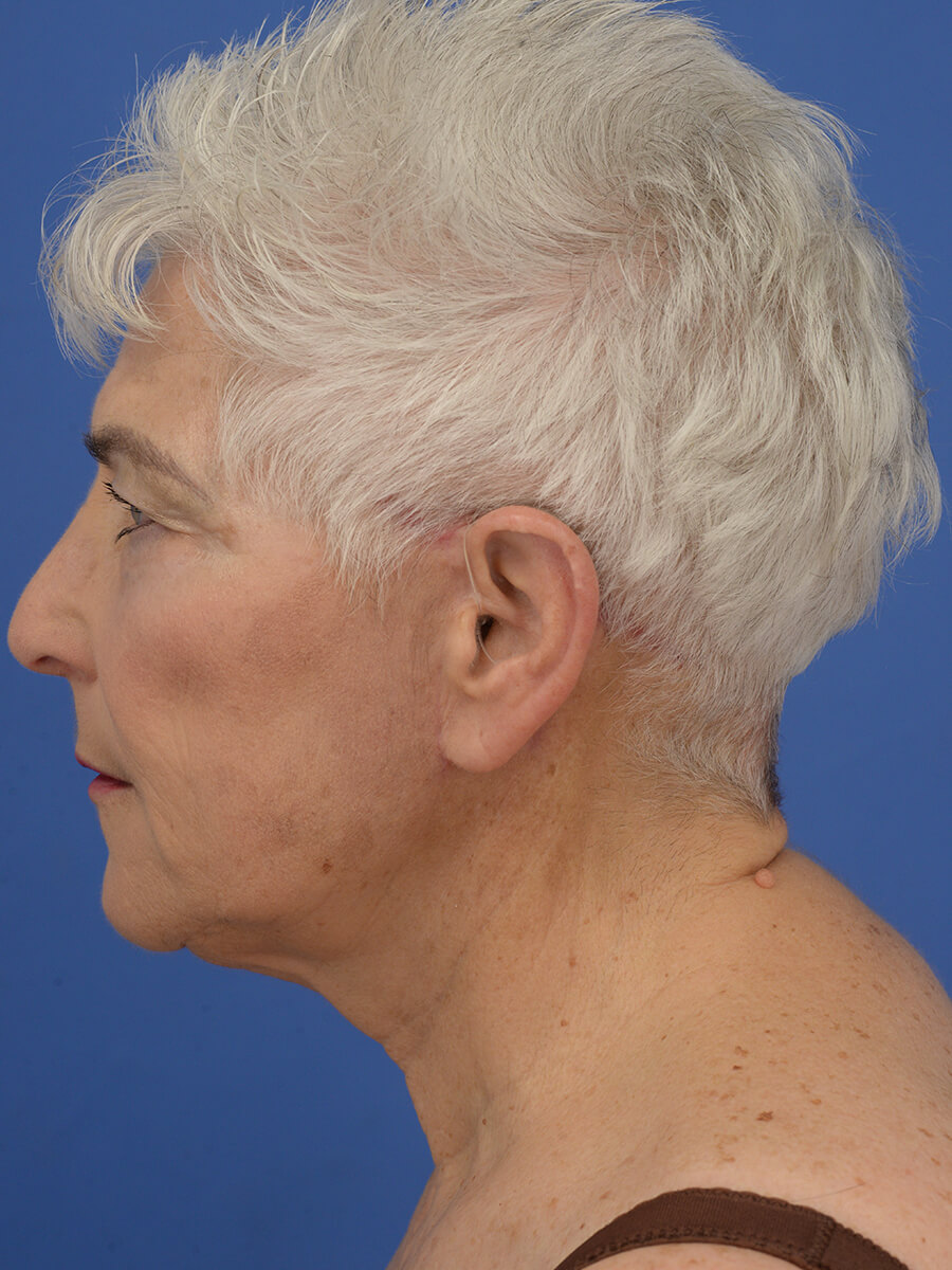 Case--5520 | After Face 3