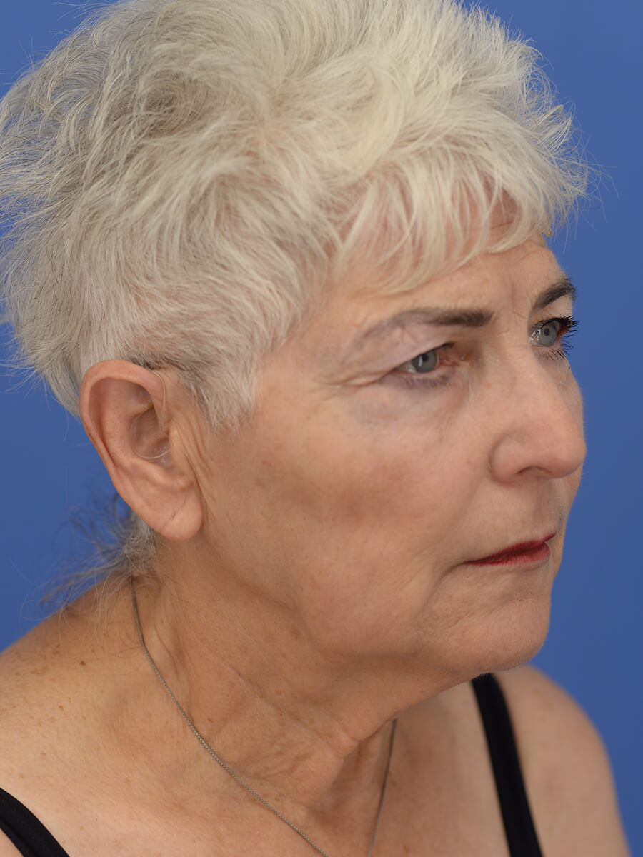 Case--5520 | Before Face 4