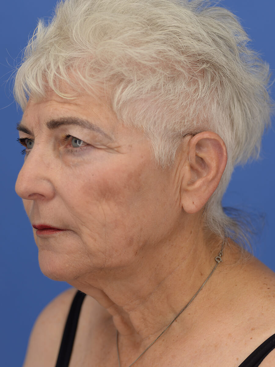 Case--5520 | Before Face 2