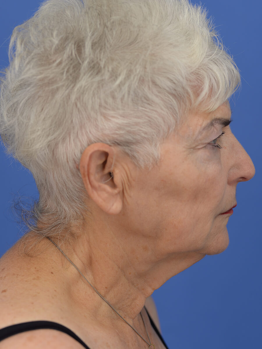 Case--5520 | Before Face 5