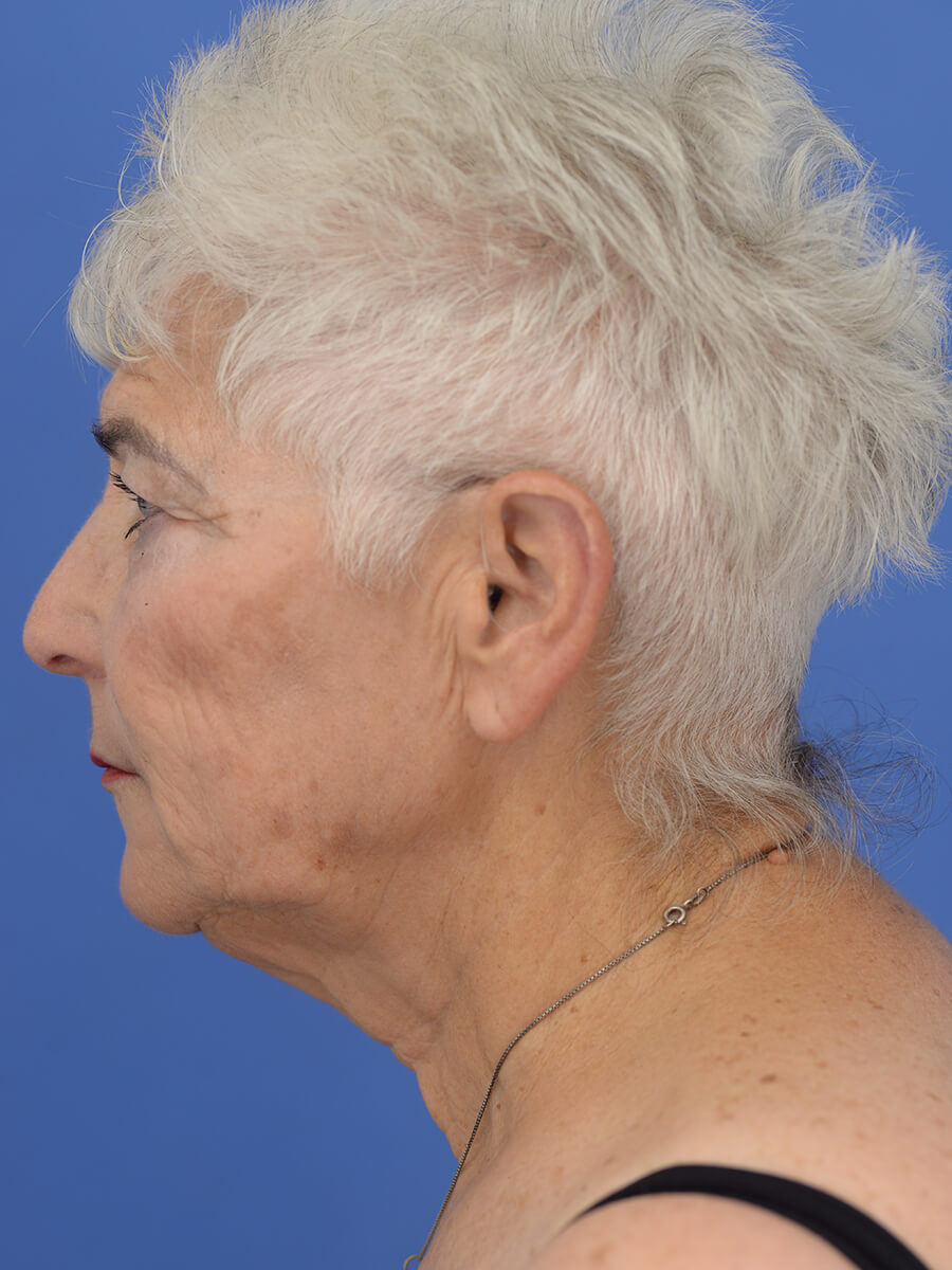 Case--5520 | Before Face 3