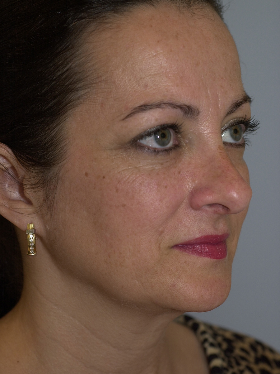 Case--4665 | After Face 2