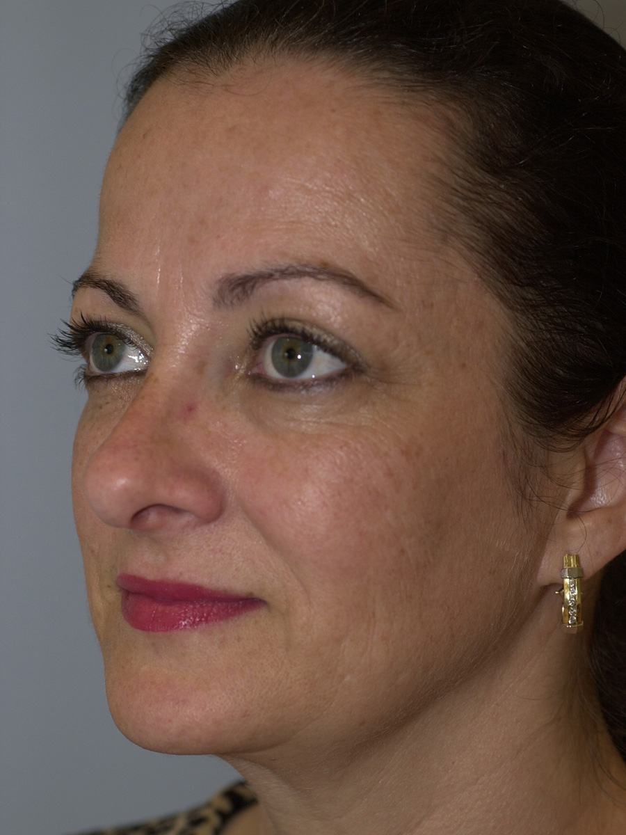 Case--4665 | After Face 3