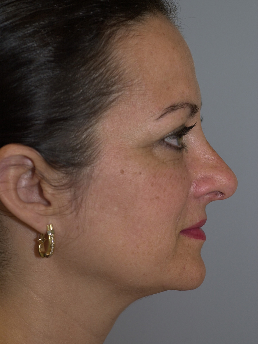 Case--4665 | After Face 4