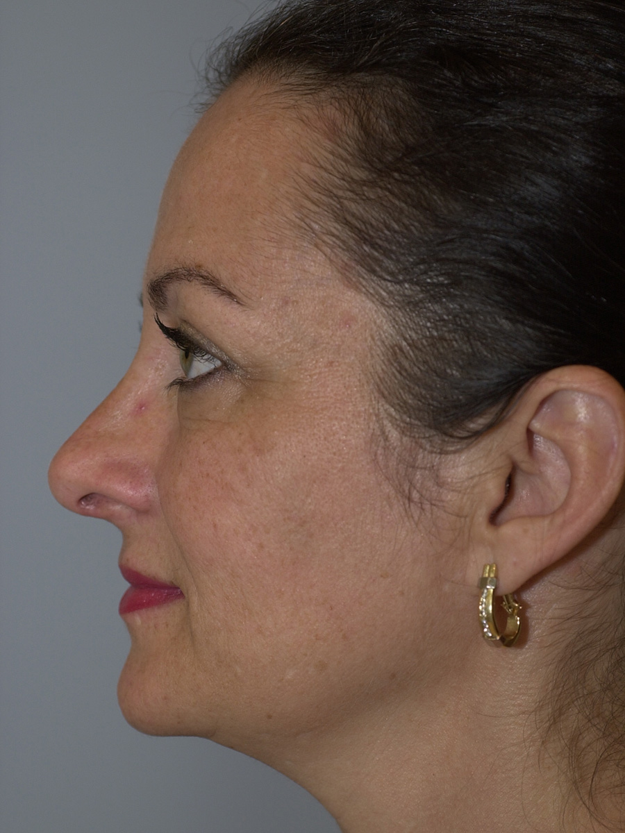 Case--4665 | After Face 5