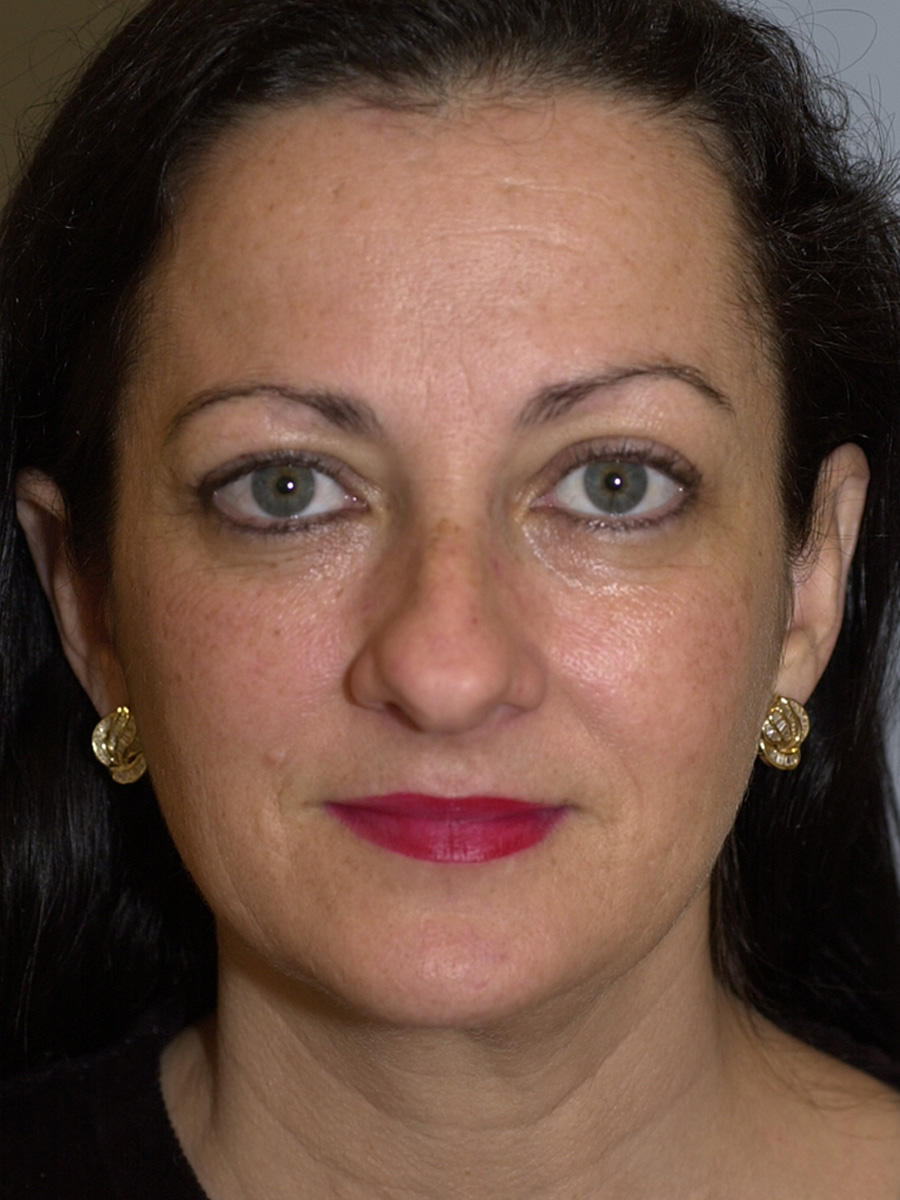 Case--4665 | Before Face 1