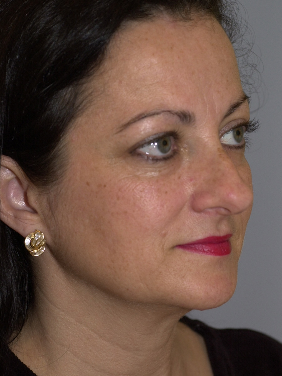 Case--4665 | Before Face 2