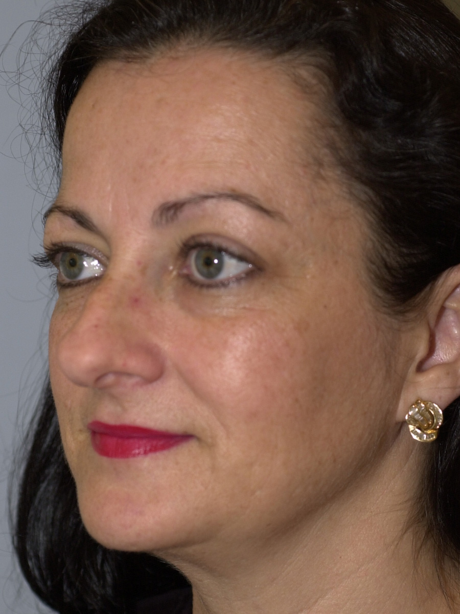 Case--4665 | Before Face 3