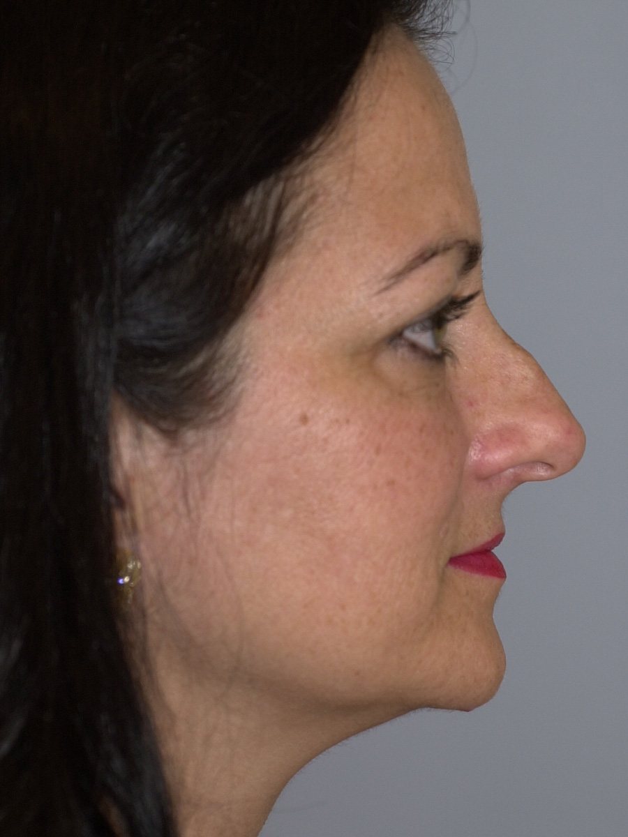 Case--4665 | Before Face 4