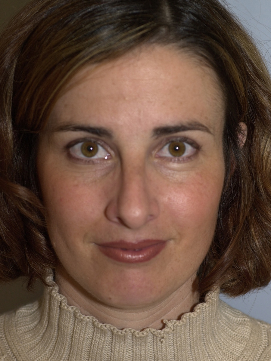 Case--7414 | After Face 1