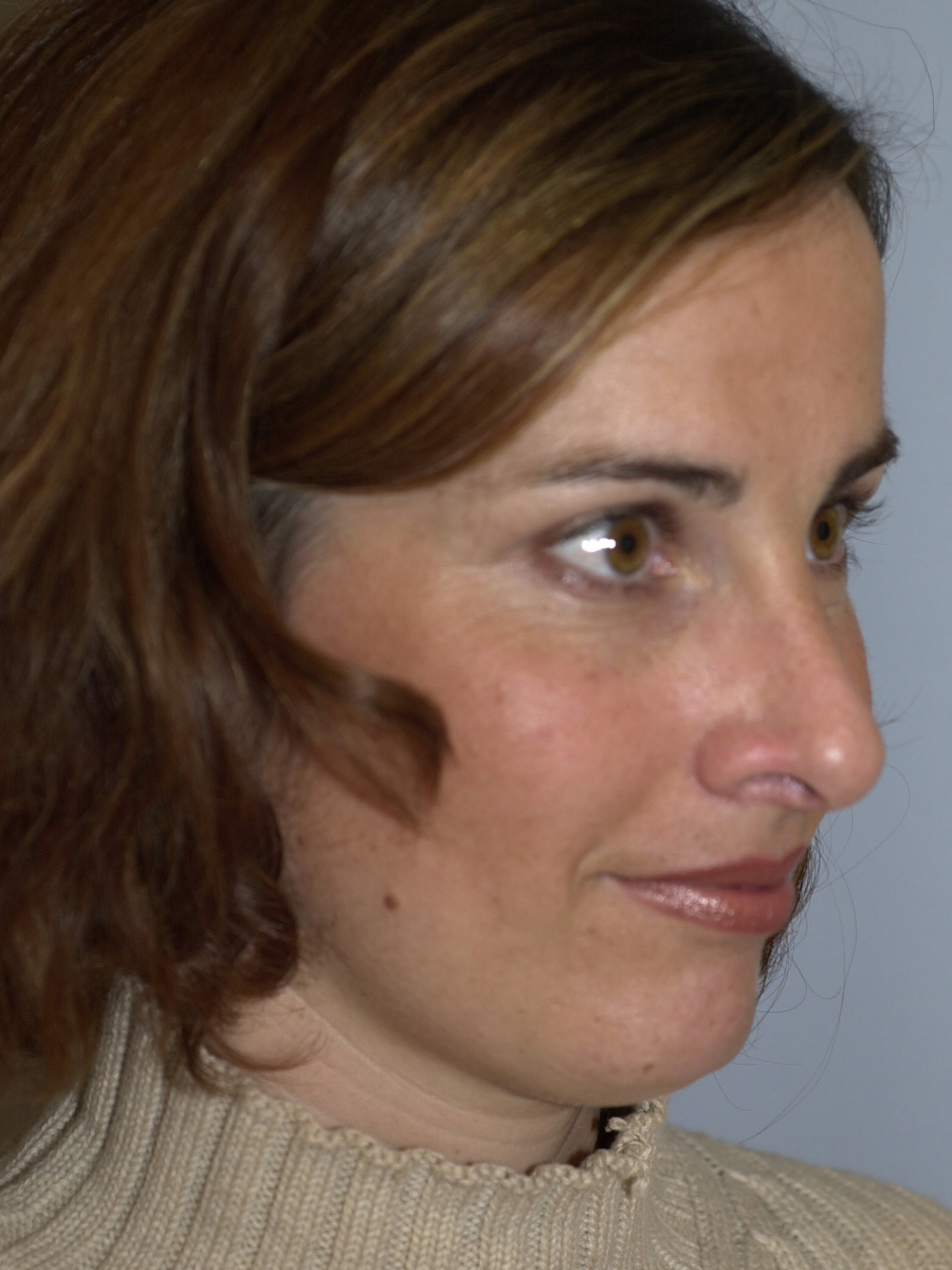 Case--7414 | After Face 2