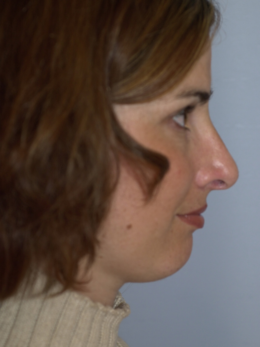 Case--7414 | After Face 4