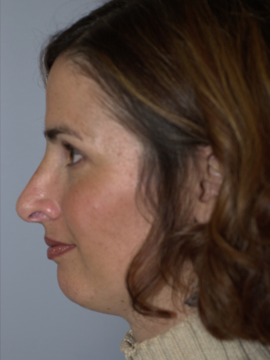 Case--7414 | After Face 5