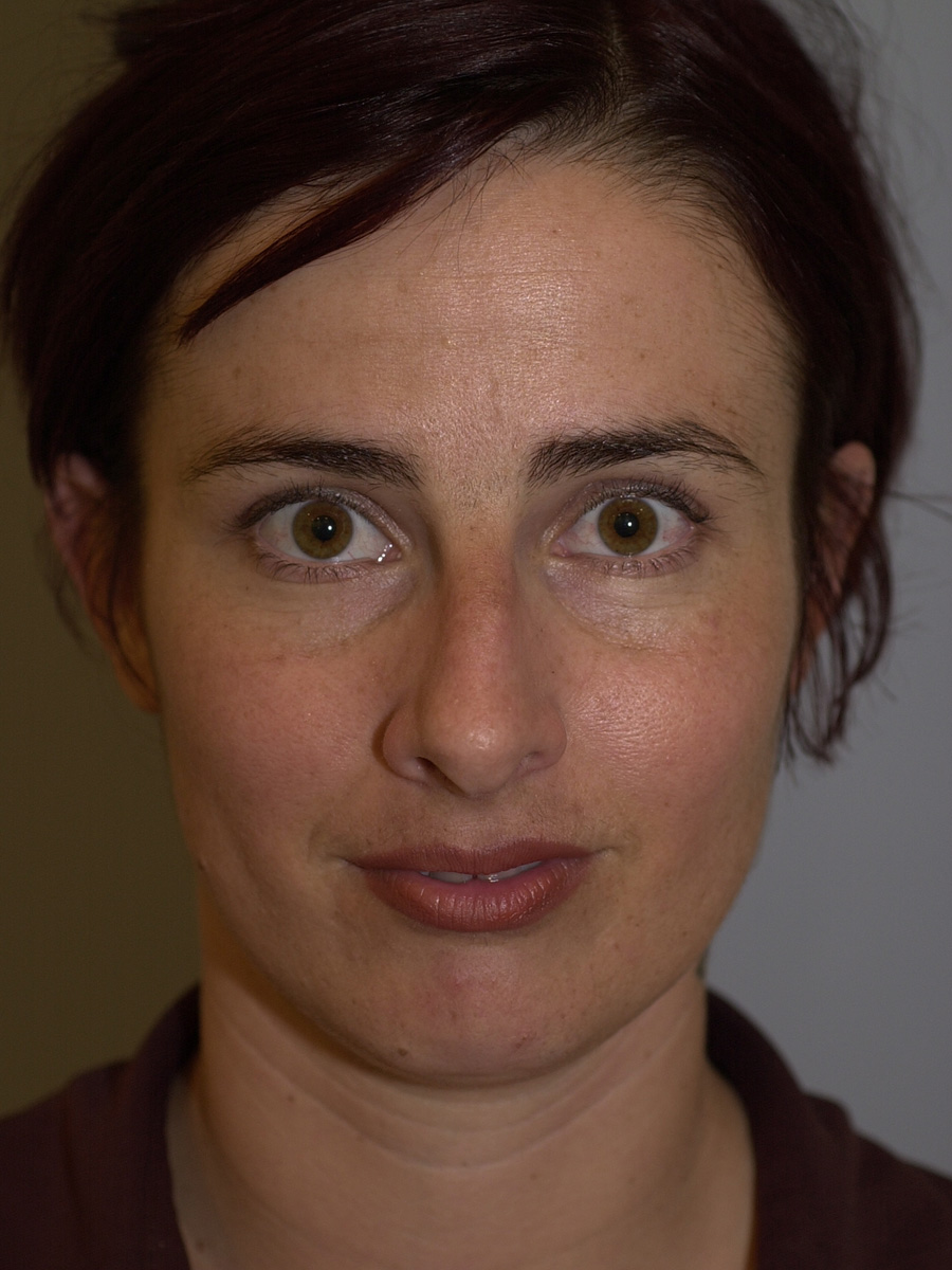 Case--7414 | Before Face 1