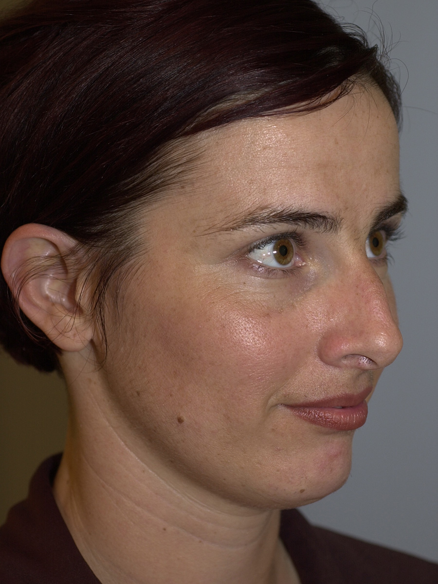 Case--7414 | Before Face 2