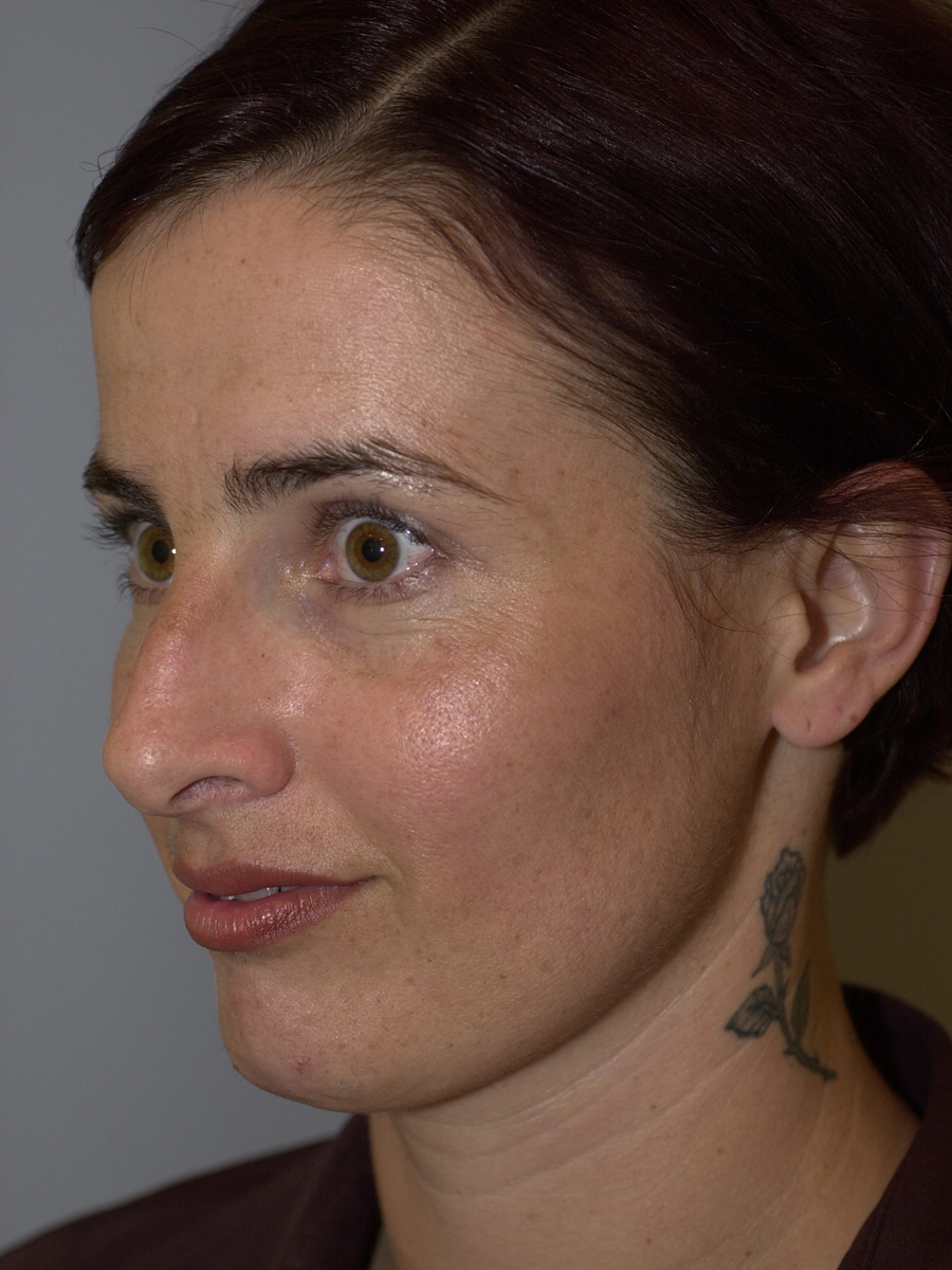 Case--7414 | Before Face 3