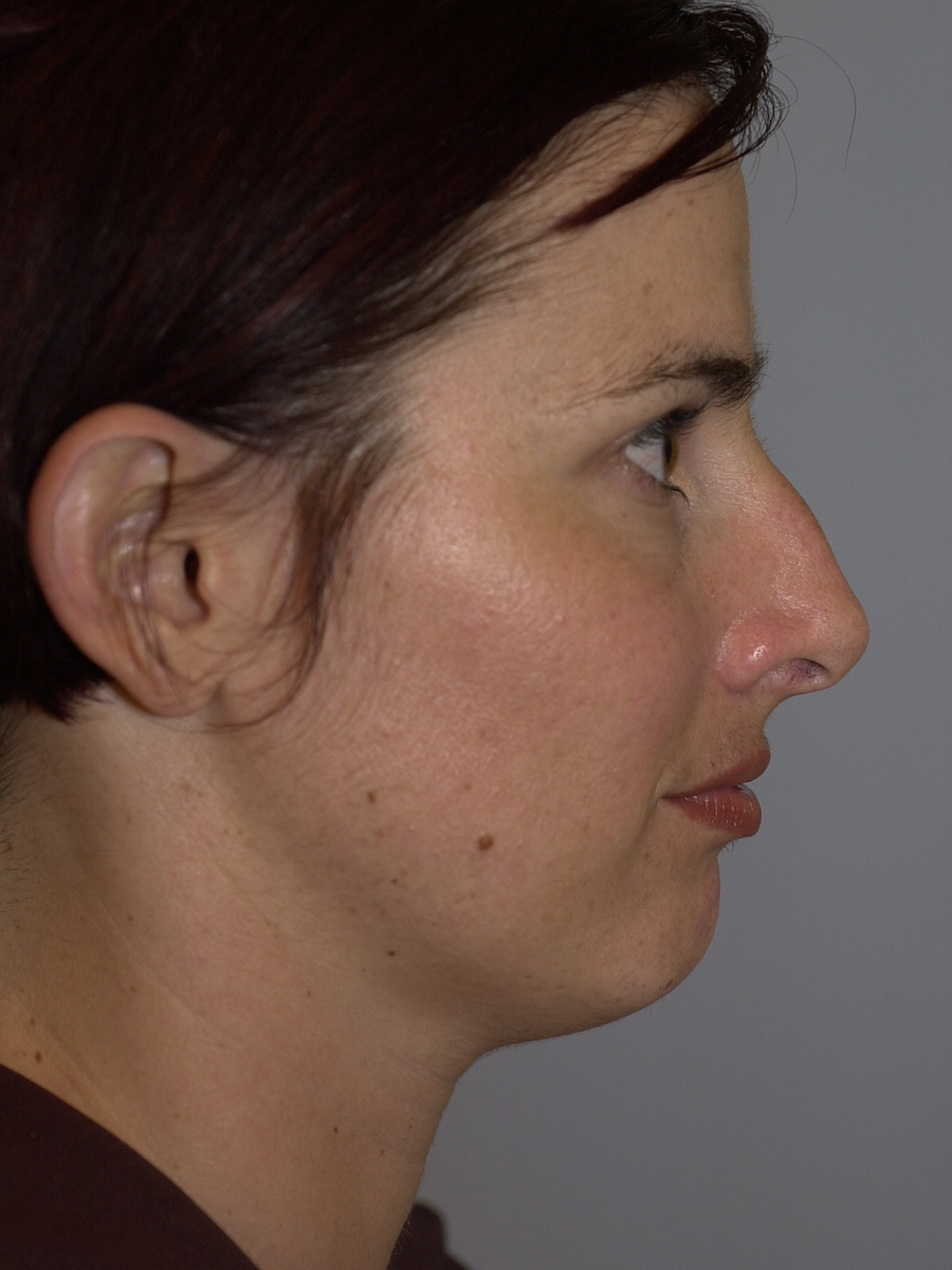 Case--7414 | Before Face 4