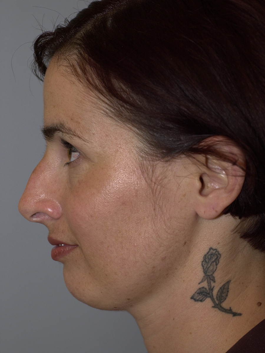 Case--7414 | Before Face 5